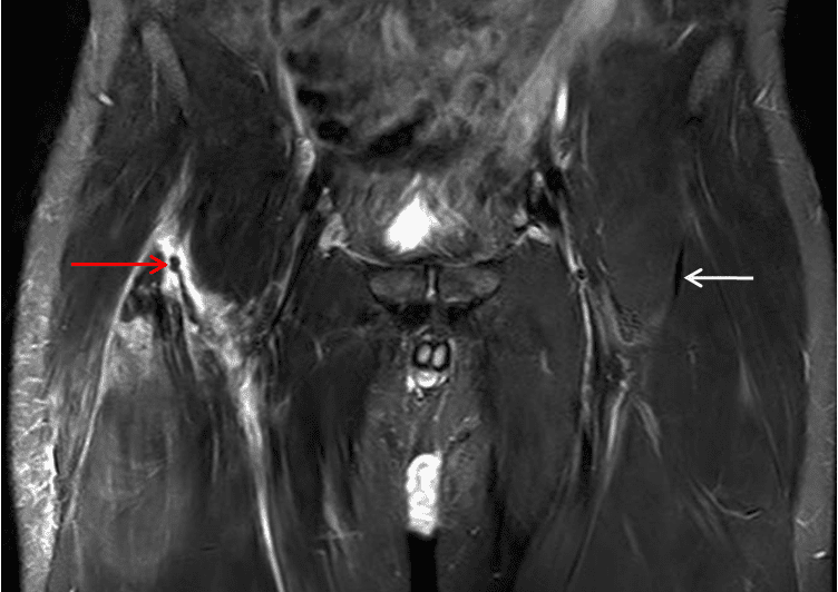 Rectus Femoris Strain Management