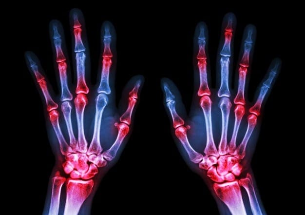 Diagnosis and Management of Rheumatoid Arthritis