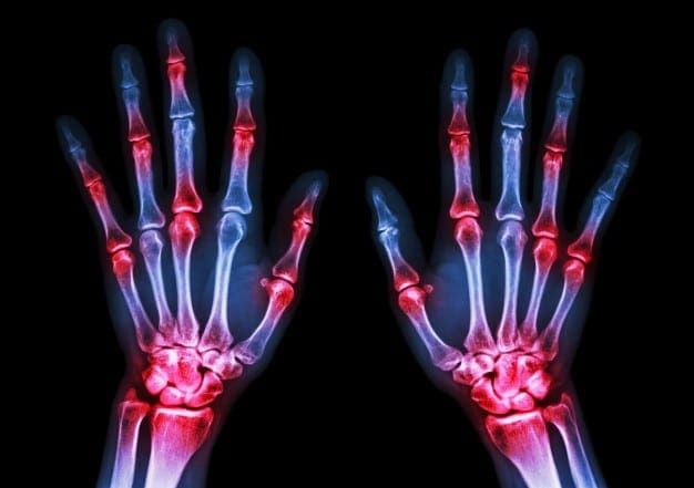 Ogaanshaha iyo Maareynta Arthritis Rheumatoid