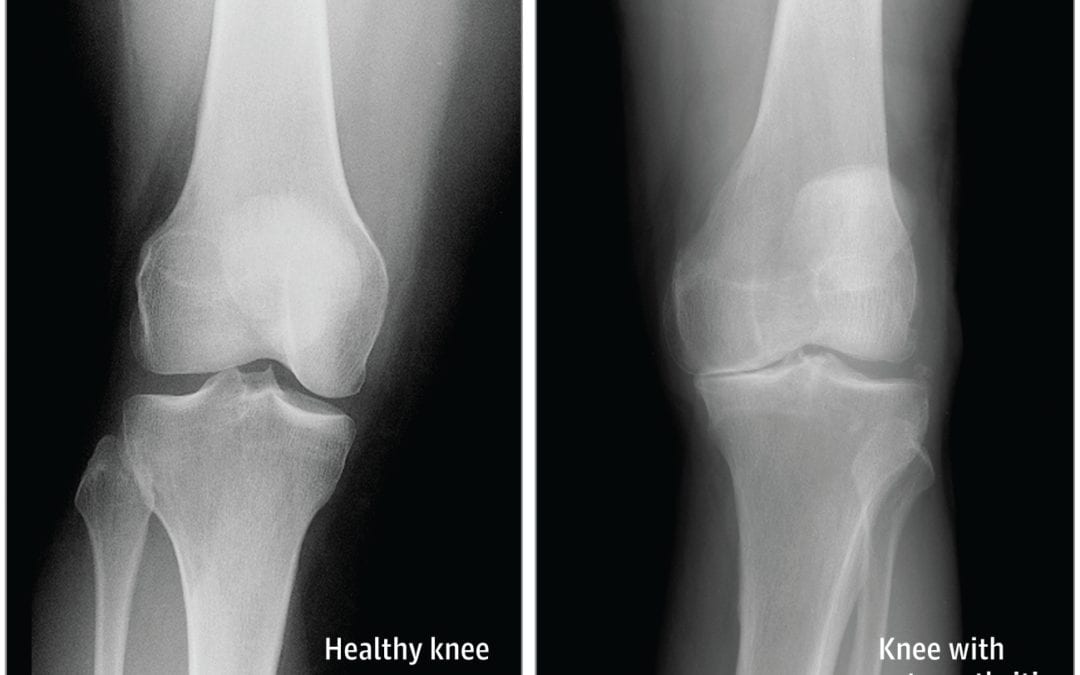 How Arthritis Can Affect the Knee