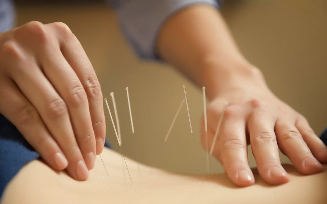 Is Acupuncture for Chiropractors Legal?