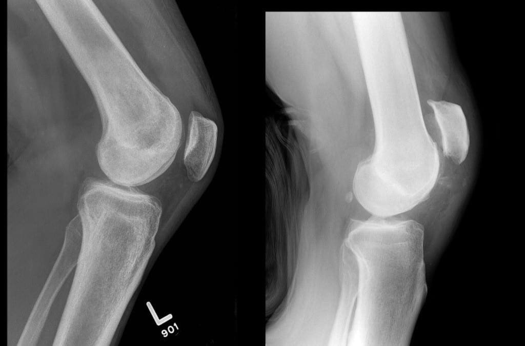 Hvad er en Quadriceps Tendon Rupture?