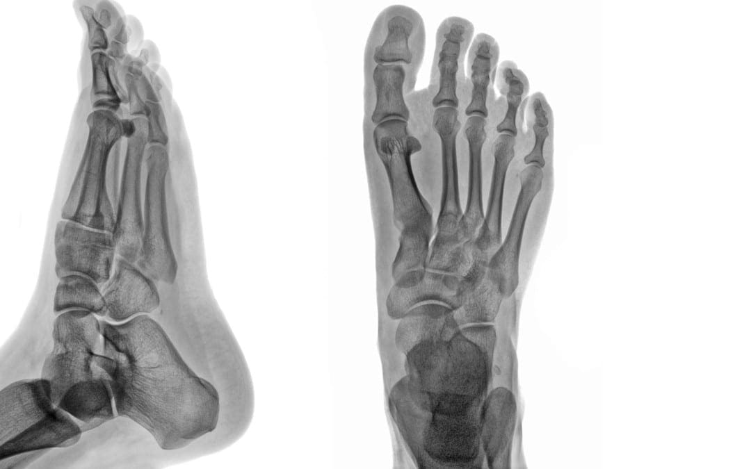 Ankle & Foot Diagnostic Imaging Artritis & Trauma I | El Paso, TX.