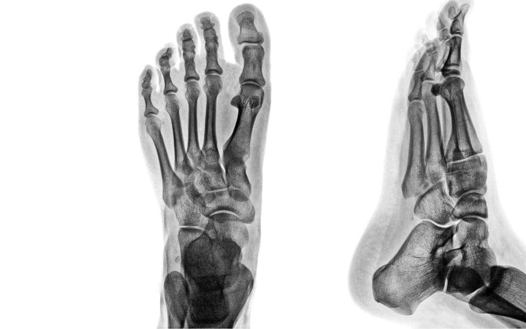 Artrite e trauma di imaging diagnostico alla caviglia e ai piedi II | El Paso, TX.