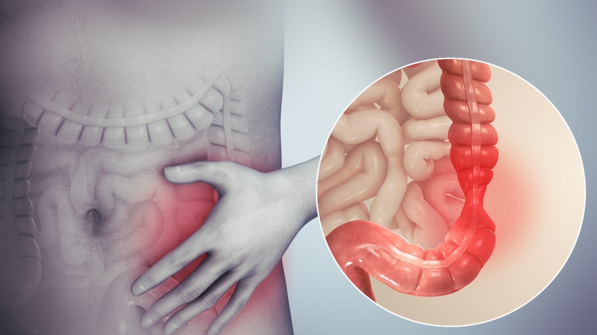 Sindrome dell'intestino irritabile