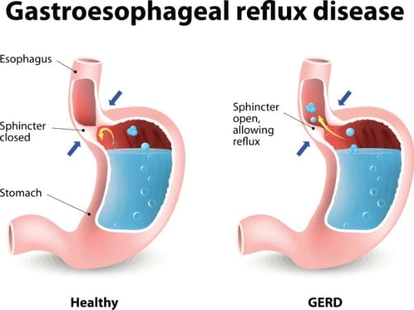 GERD-നെ കുറിച്ച് നിങ്ങൾ അറിയേണ്ടത്