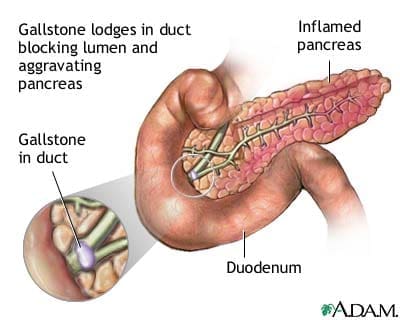 pancreatite cronica