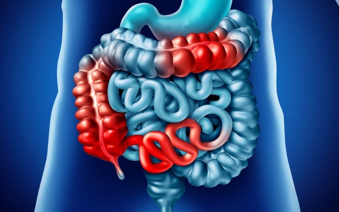 Cos'è la malattia di Crohn? Una panoramica | El Paso, TX Chiropractor