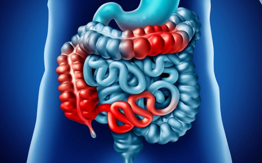 Cos'è la malattia di Crohn? Una panoramica