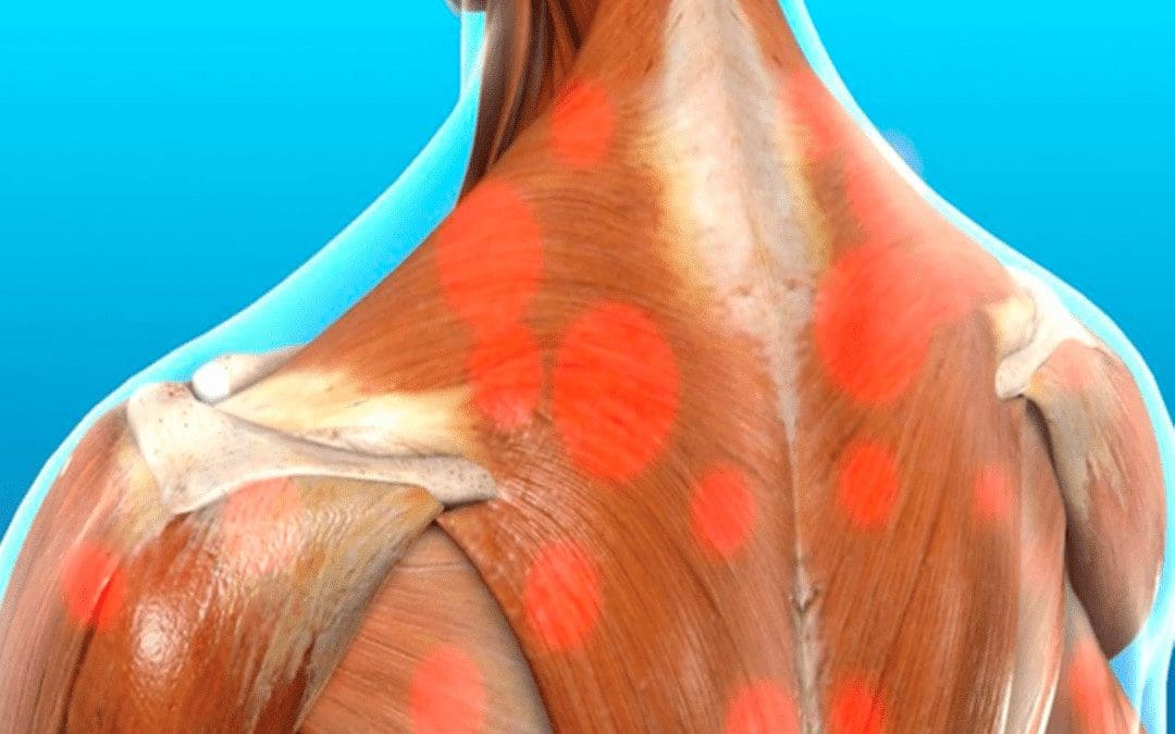 Bolesť myofasciálneho spúšťača ovplyvňujúca trapézový sval