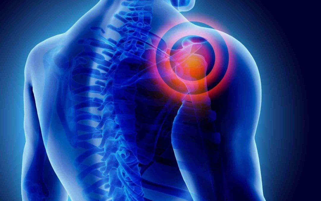 Shoulder Joint Pain Associated With Trigger Points