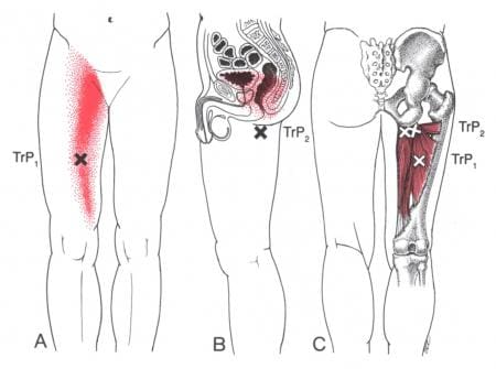 Pain In Your Adductor Muscles? Could Be Myofascial Trigger Points