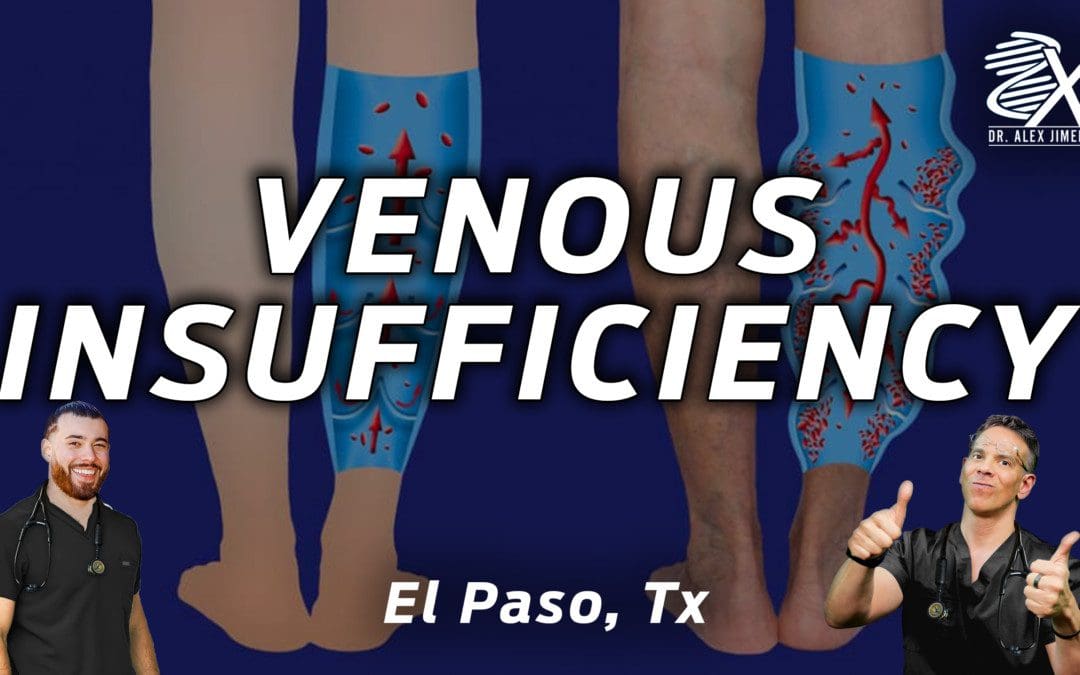 What You Need To Know About Venous Insufficiency