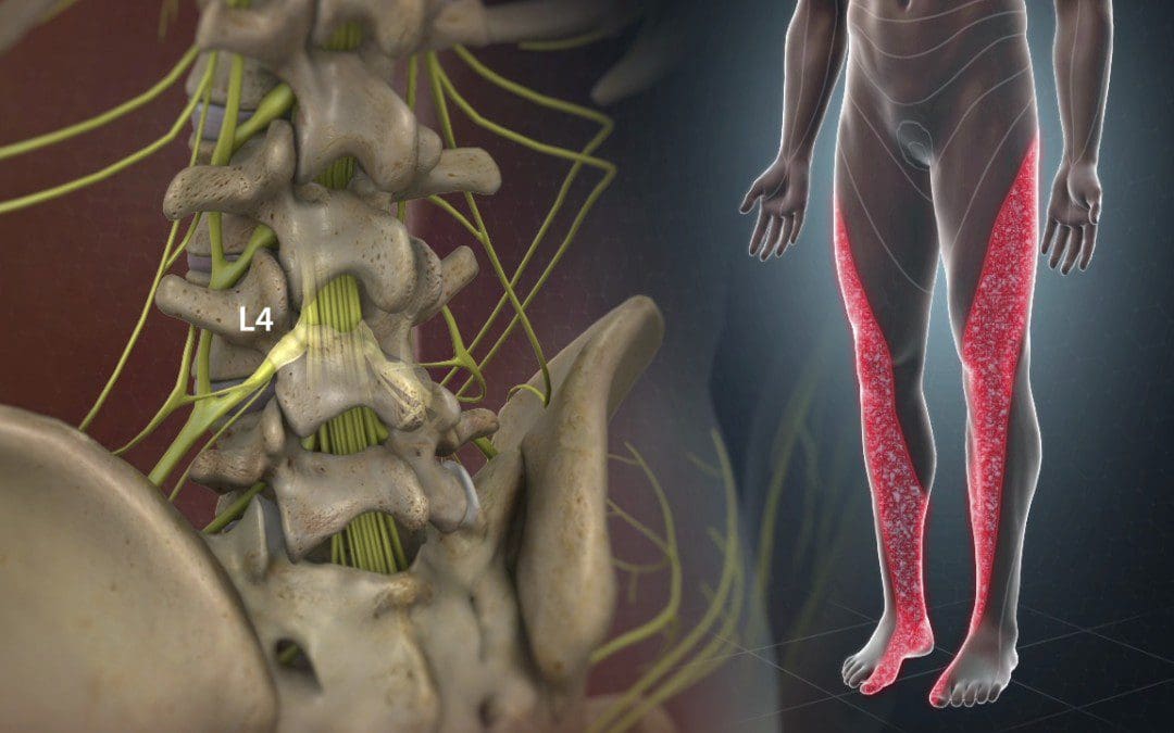 Incorporating Spinal Decompression Treatments For Lumbosacral Pain