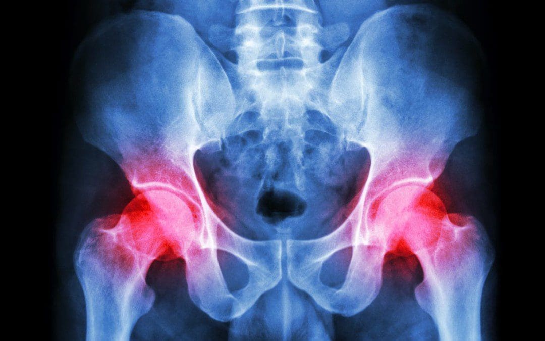 MET Treatment Strategies To Reduce Pelvic Pain