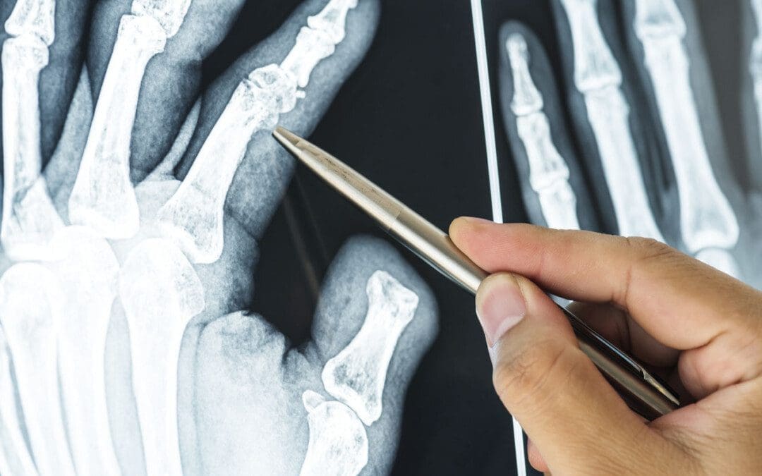 How to Identify and Treat Finger Sprains and Dislocations