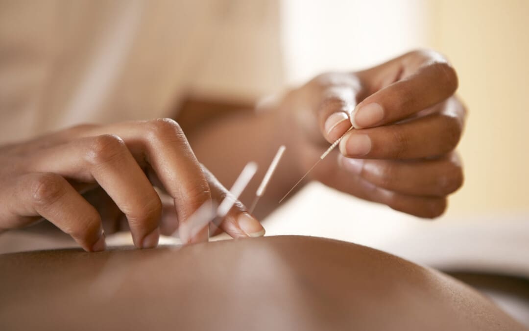 The Benefits of Acupuncture for Pelvic Pain Relief