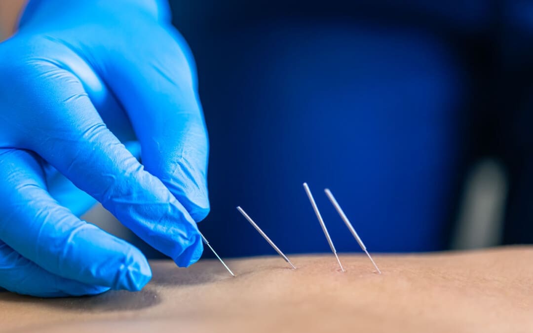 The Benefits of Acupuncture for Arthritis Explained