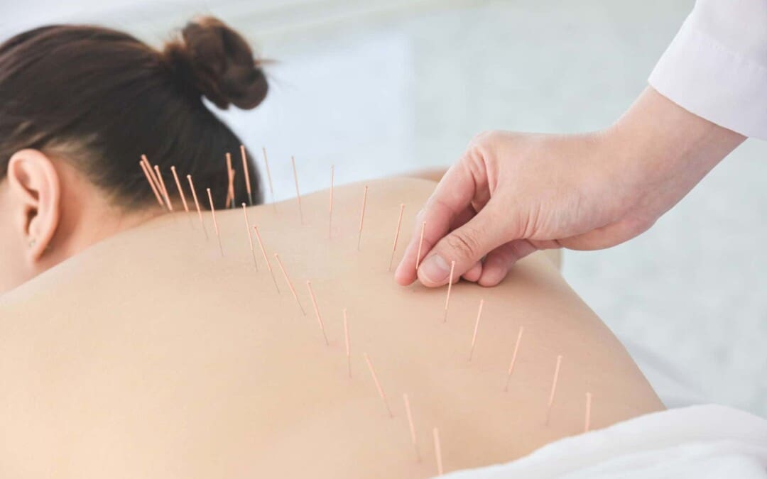 Understanding the Benefits of Acupuncture for Low Back Pain