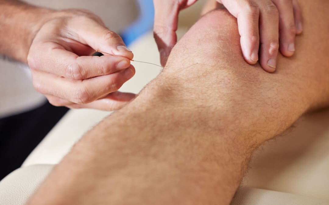 How Acupuncture Can Help Alleviate Knee Pain