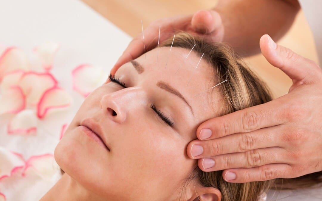Say Goodbye to Headaches with Acupuncture