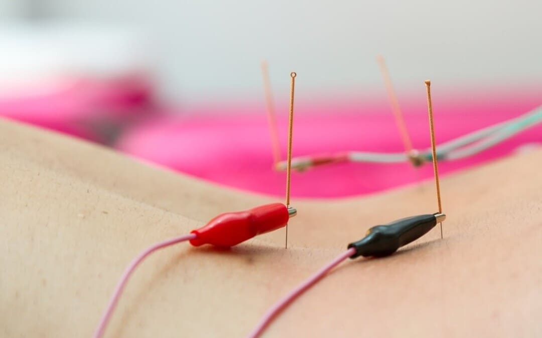 Awọn anfani ti Electroacupuncture lori Eto iṣan