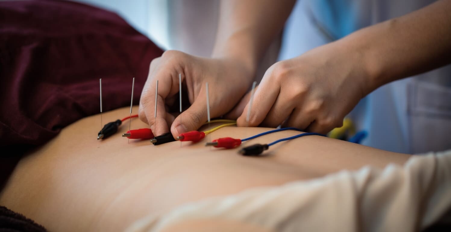 Electroacupuncture: Benefits and Uses for Pain Relief