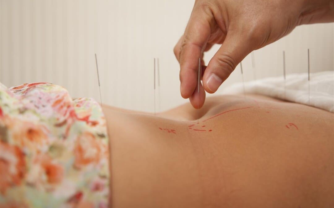 Acupuncture for Reducing Joint Pain in Lupus: A Natural Approach