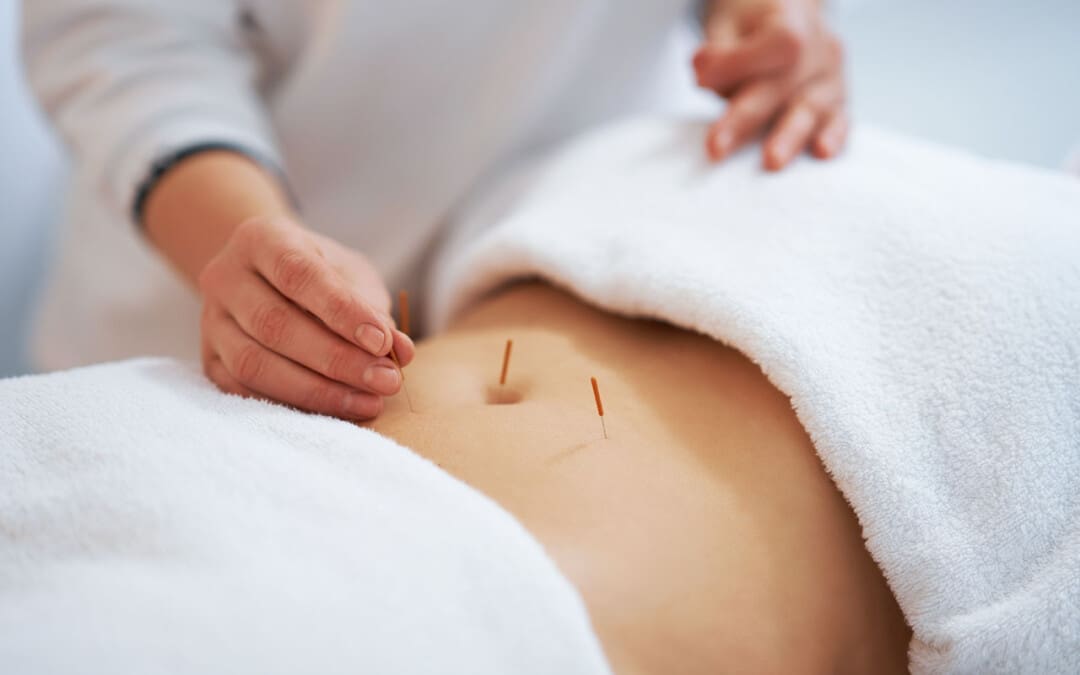 Rola Acupuncture di Birêvebirina Nîşaneyên Kolîta Ulcerative de