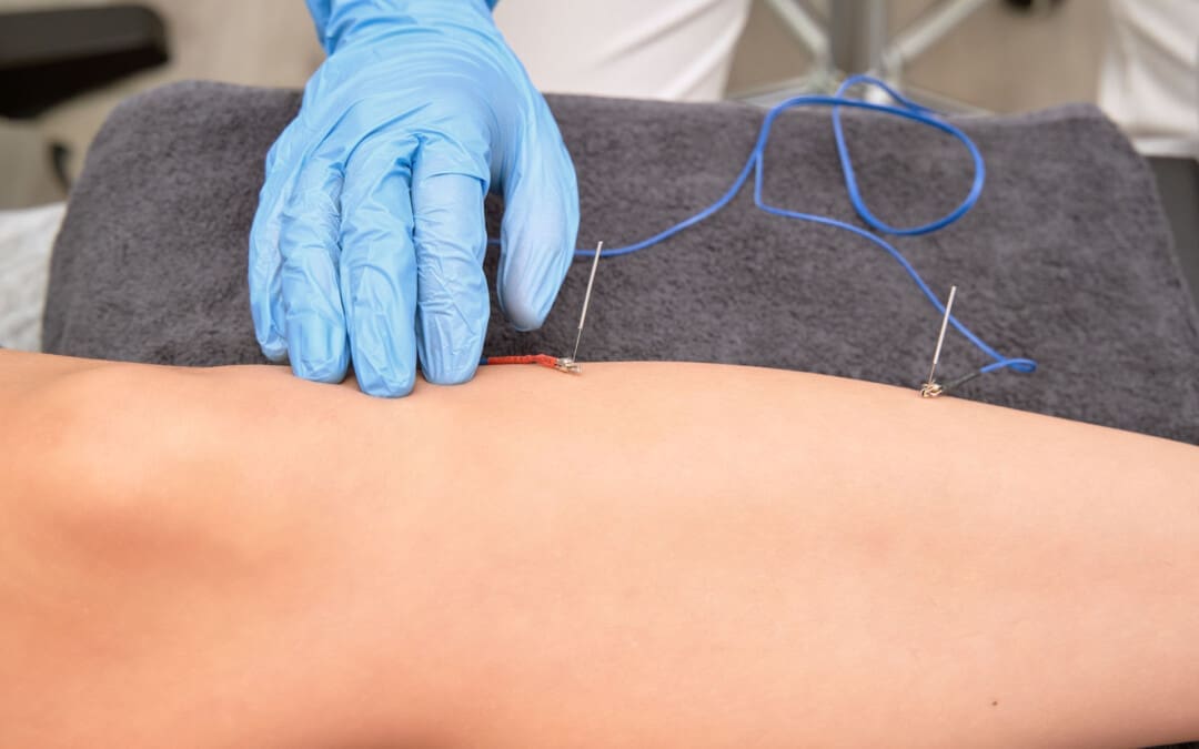 Debunking the Fear: Is Acupuncture Painful?